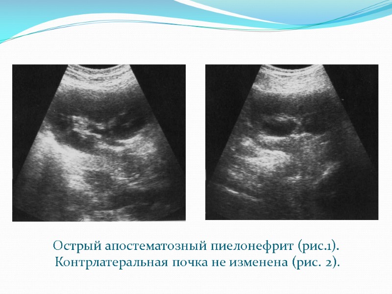 Острый апостематозный пиелонефрит (рис.1).  Контрлатеральная почка не изменена (рис. 2).